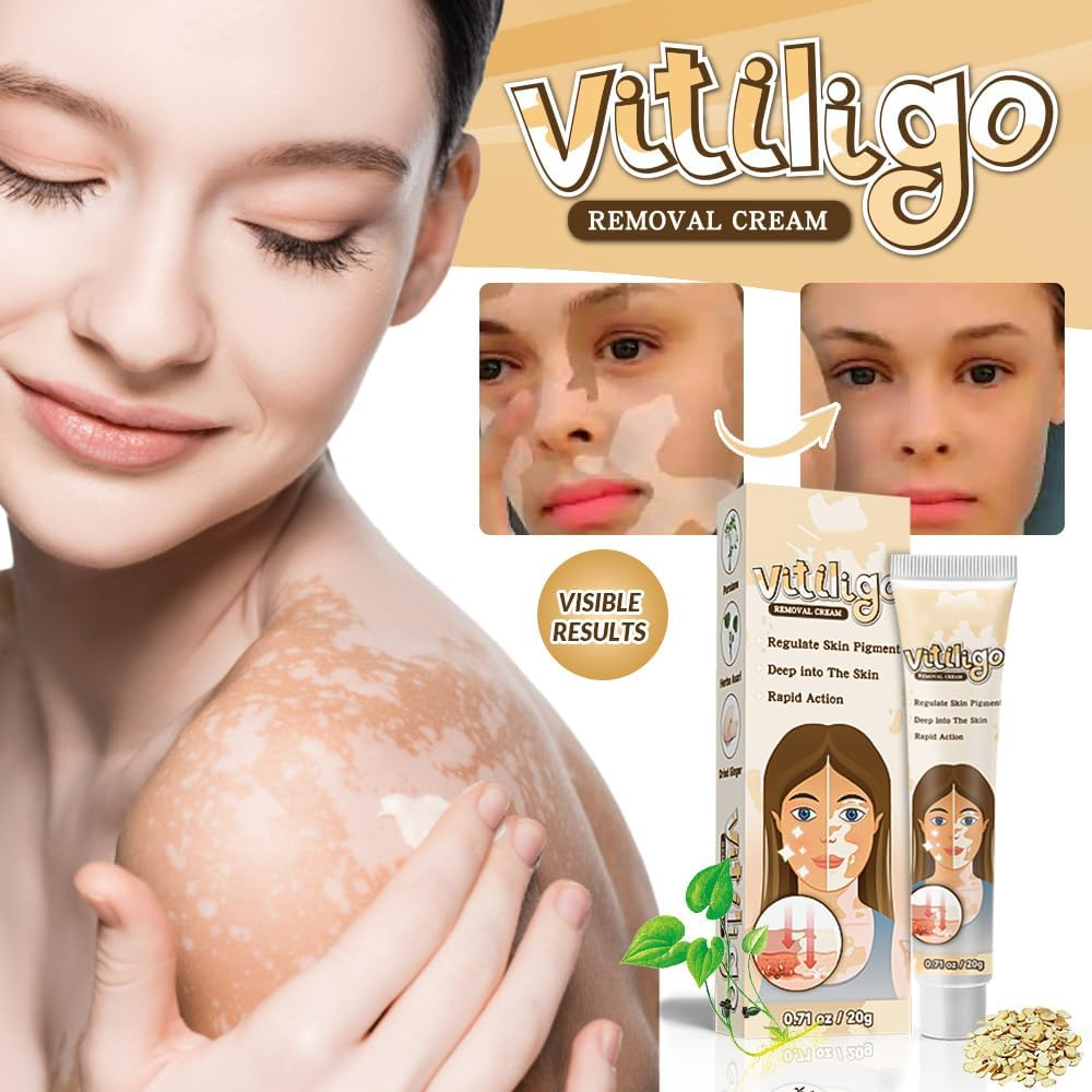 Natural Vitiligo Cream