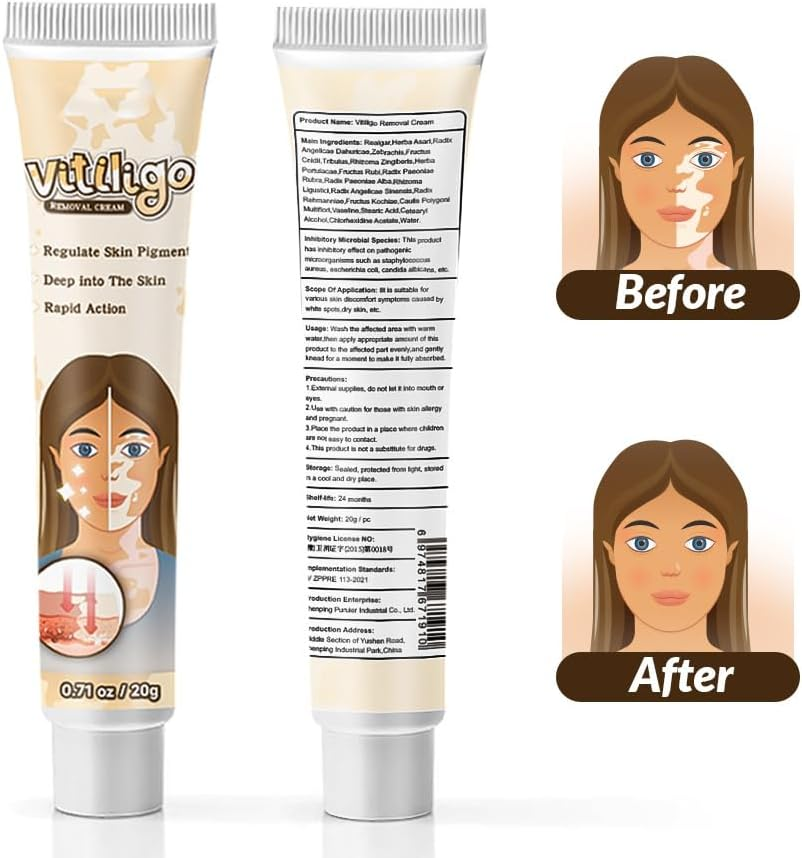 Natural Vitiligo Cream